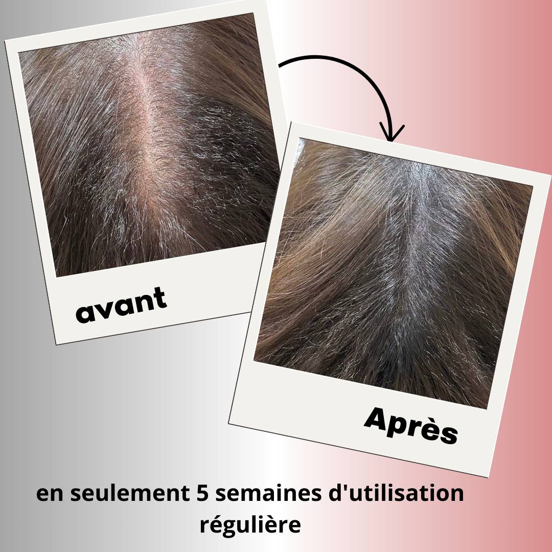 PeloZen™ | Stoppez la chute de cheveux  et retrouvez une chevelure dense en 21 jours
